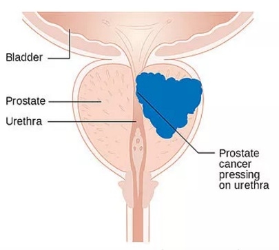 Software optimiza radioterapia para cáncer de próstata